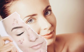 ¿Qué es el acné? Como tratarlo
